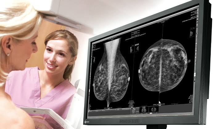 Extensão - Mamografia